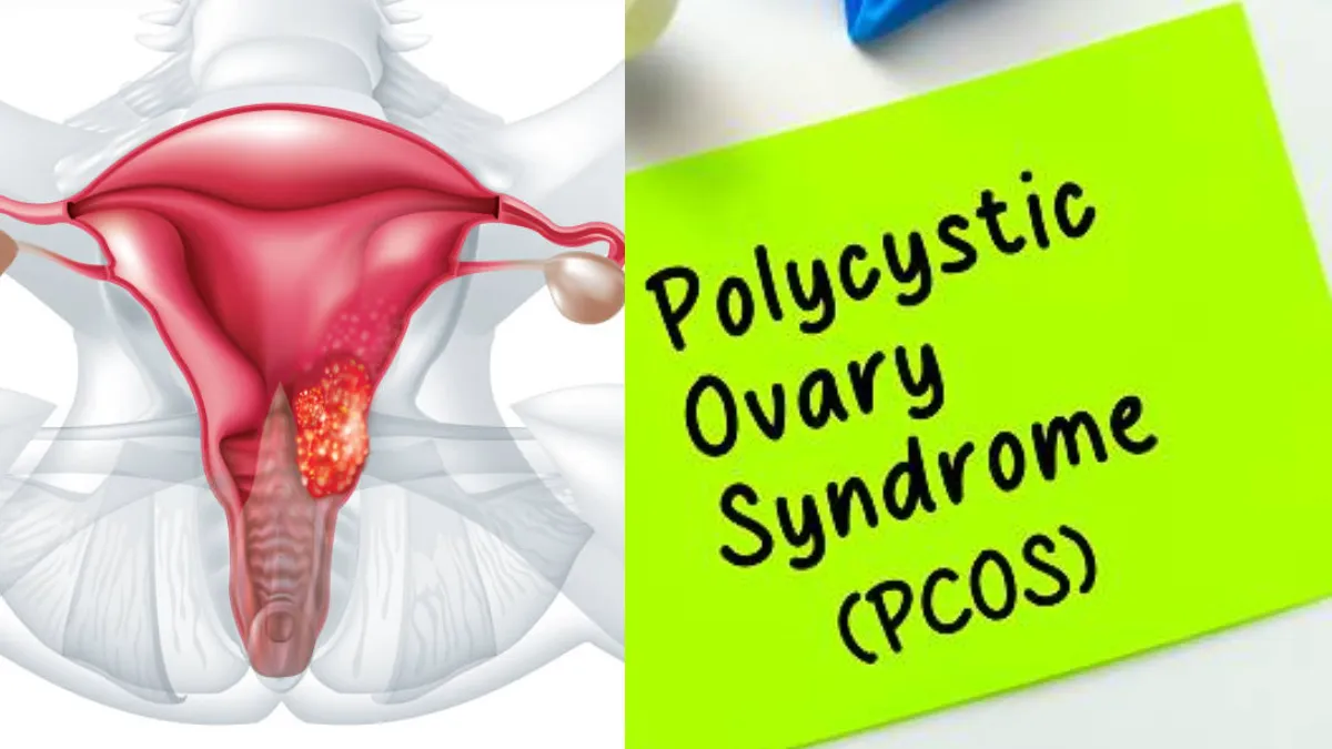 PCOS Ko Kaise Thik Kare In Hindi