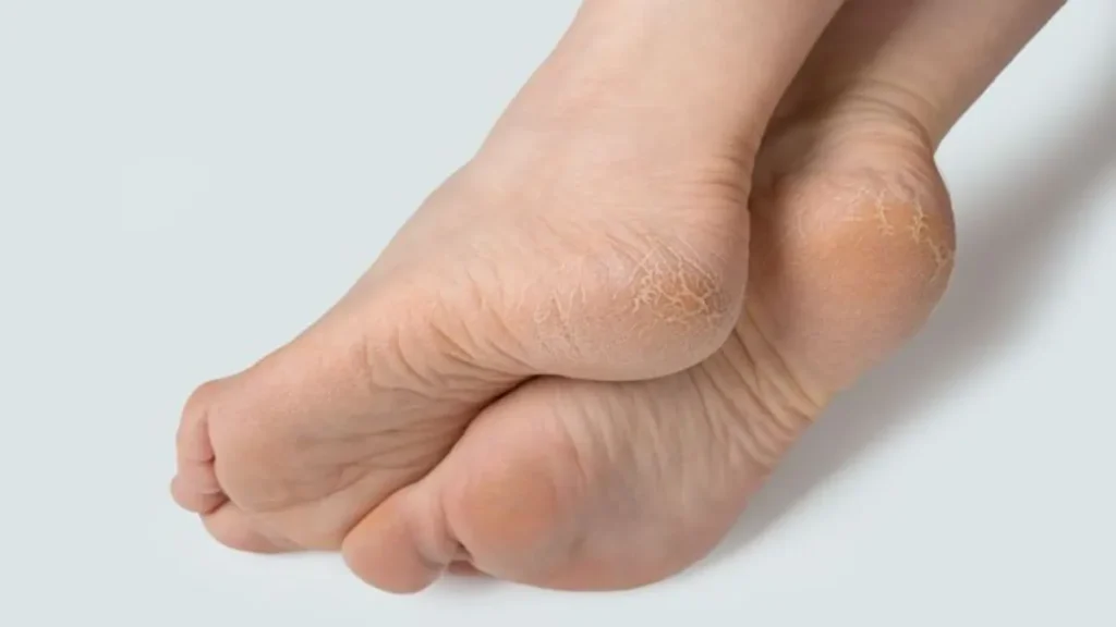 Fati Ediyon Ke Liye Gharelu Upay