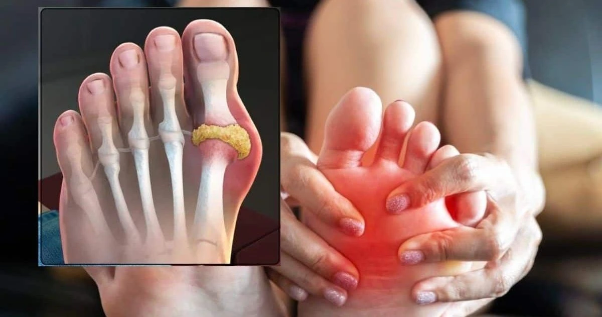 uric acid ko kam karne ke liye chatni